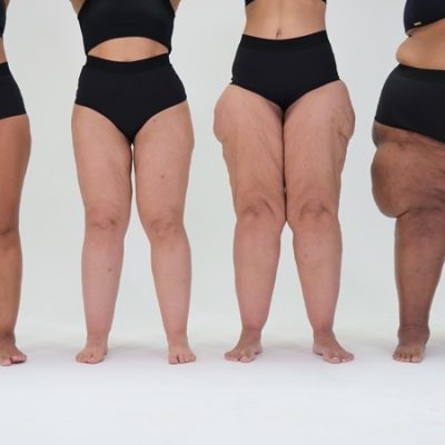 Mulheres com diversos graus de lipedema - crédito fotos: divulgação Conheça Lipedema @conhecalipedema