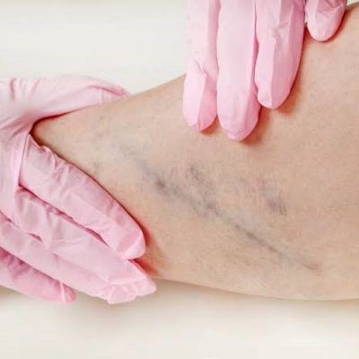 varizes é uma das doenças vasculares